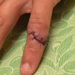 Do I Need Stitches? Find Out How To Tell