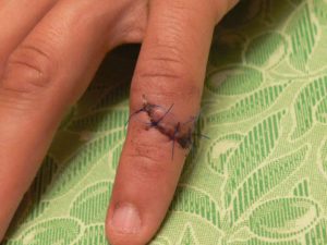 Read more about the article Do I Need Stitches? Find Out How To Tell