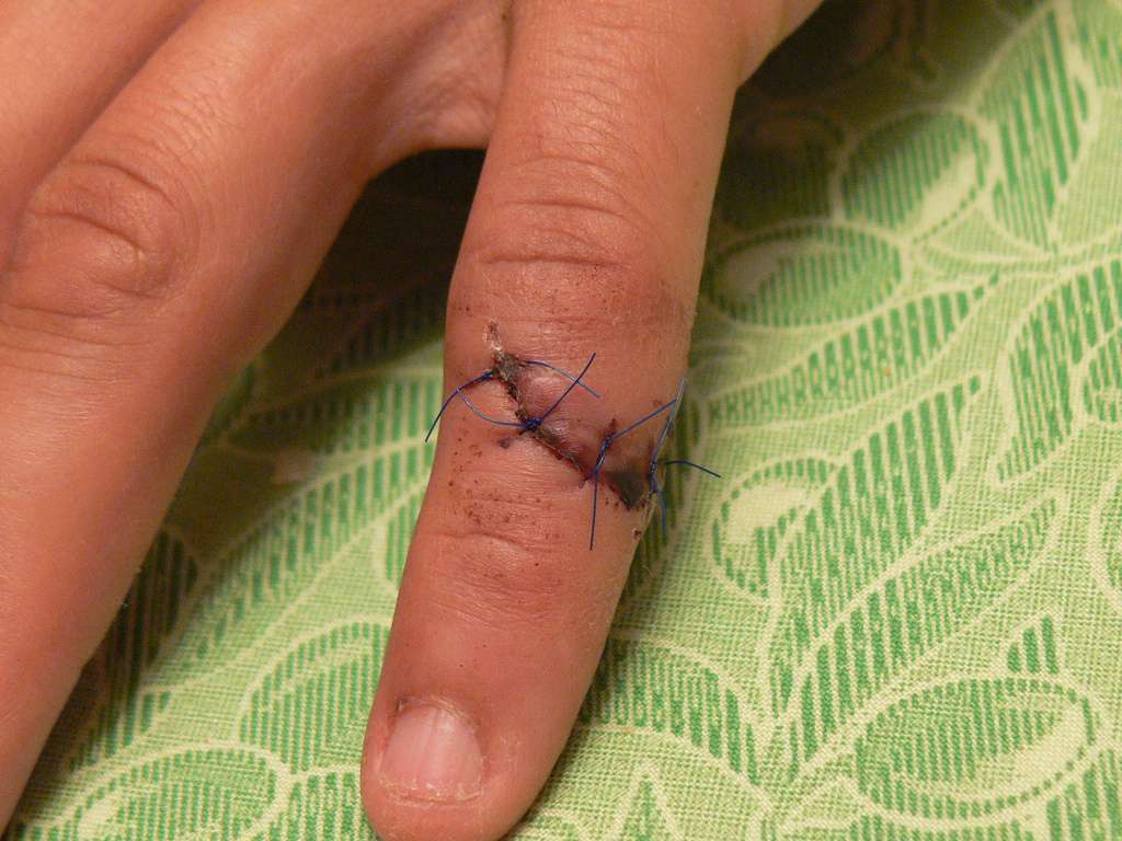 laceration example showing stitches