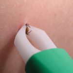 How to remove a tick?